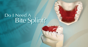 Orthodontic Bite Splint
