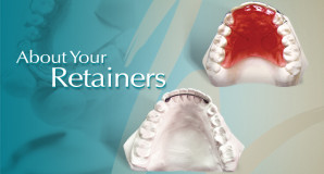 Orthodontic Retainer for Braces Treatment